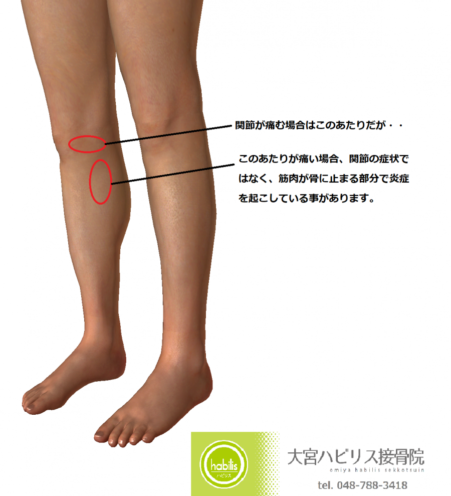 膝の関節の痛みと混同しやすい、鵞足包（がそく・ほう）の痛み