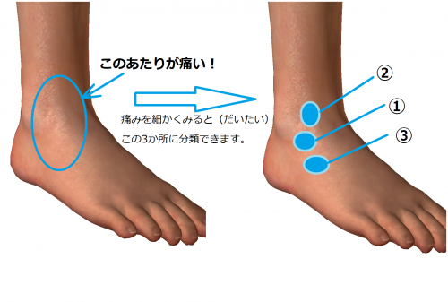 ハビリス診察室 外くるぶしが痛い 足首捻挫の基本 1 大宮ハビリス接骨院 院長ブログ